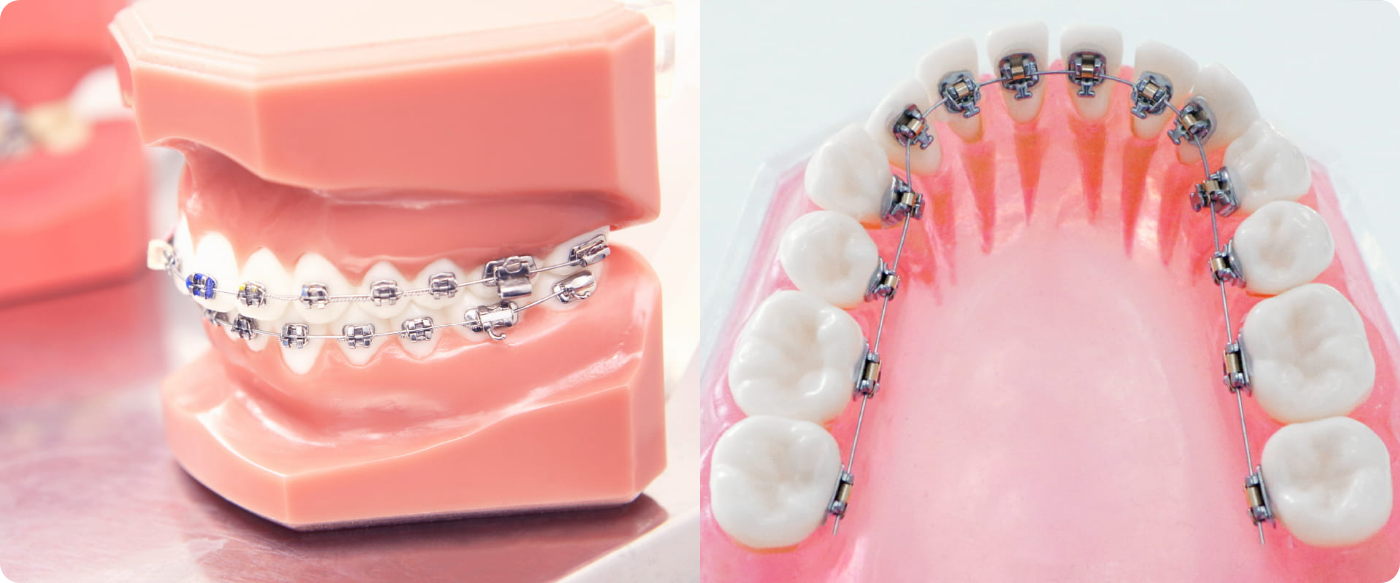 ほとんどの歯列に対応できて、確実性が高いブラケット矯正