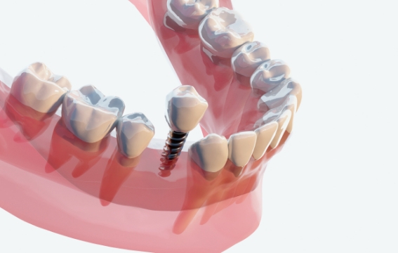 厳選のインプラントメーカー