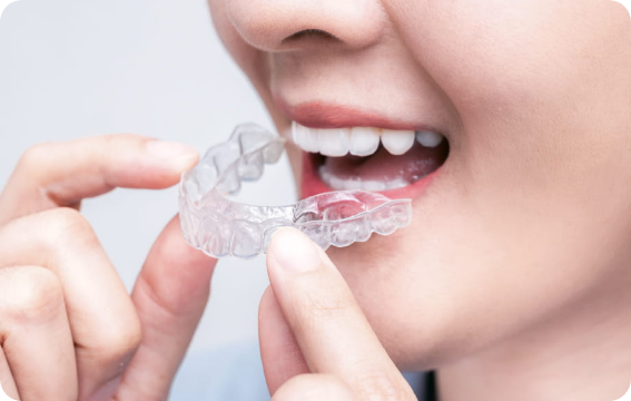 マウスピース矯正